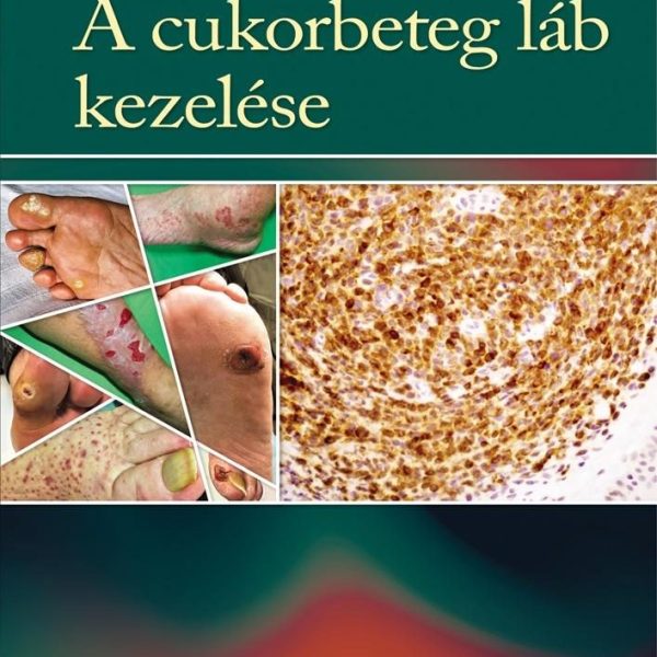 A CUKORBETEG LÁB KEZELÉSE